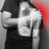 [VIDEO] Infiltración ecoguiada de la articulación acromioclavicular