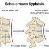 Enfermedad de Scheuermann