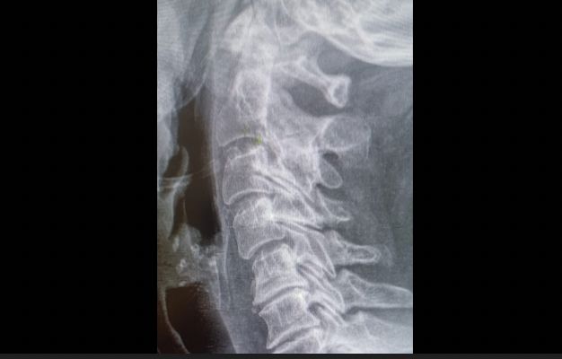Arthrose cervicale drjordijimenez