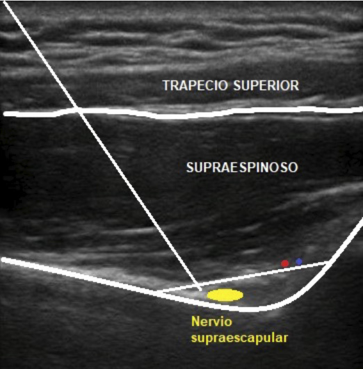 bloqueo nervio supraescapular dr. jordi jimenez