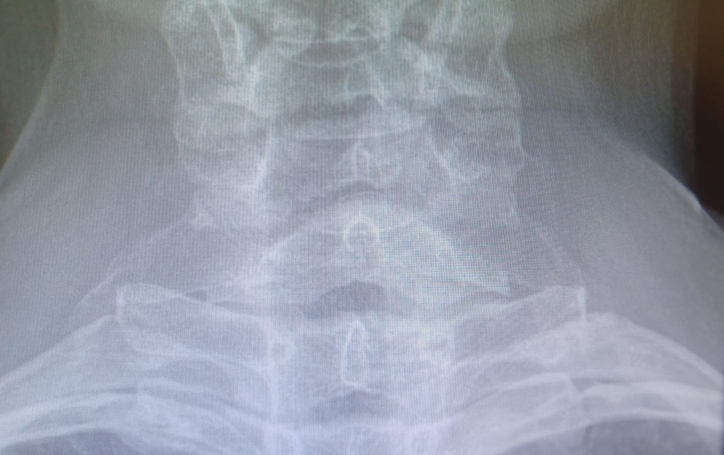 Costella cervical dreta i procés transversal c7 esquerra prominent drjordijimenez