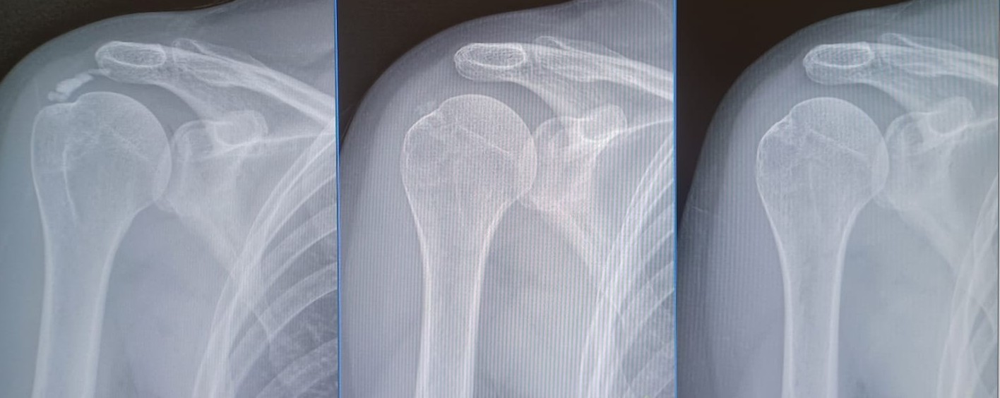 Cambios evolutivos de una calcificación del tendón del supraespinoso tras realizar técnica de barbotaje drjordijimenez