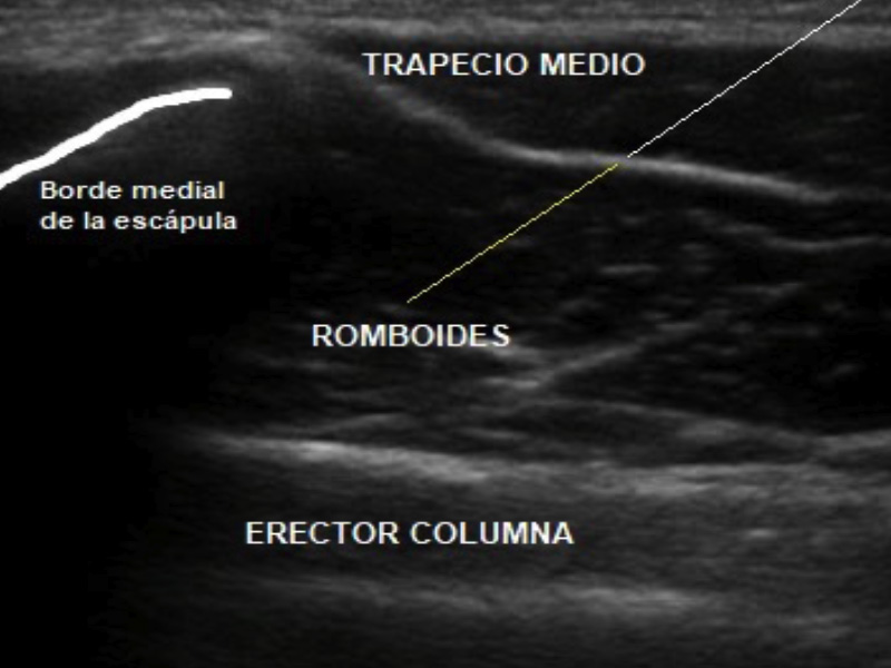 Acceso de la aguja al espacio interfascial entre trapecio medio y romboides (línea blanca) o al espesor muscular del músculo romboides (línea amarilla).