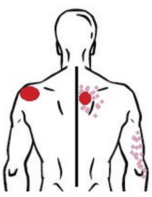 Figura 1 -  Puntos gatillo y dolor referido del músculo trapecio medio