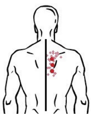  Figura 2 - Puntos gatillo y dolor referido del músculo trapecio medio