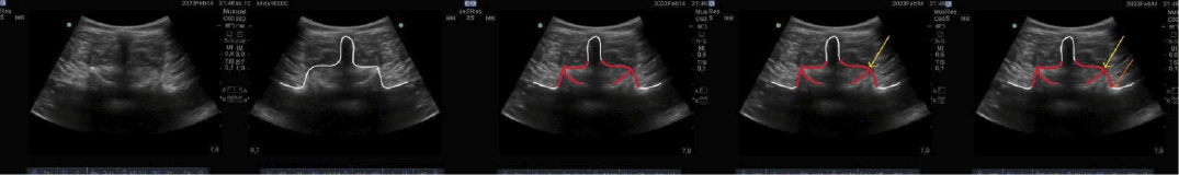 sindrome facetario lumbar dr. jordi jimenez